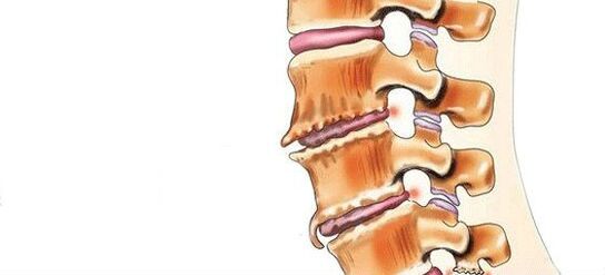 Spondylosis - ការបំផ្លាញនៃសន្លាក់អន្តរាគមន៍