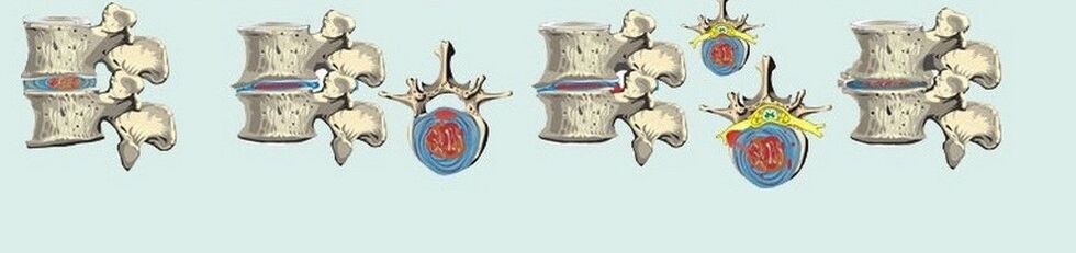 ដំណាក់កាលផ្សេងៗគ្នានៃ osteochondrosis thoracicic ostochondrosis