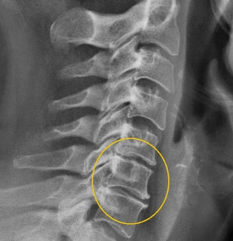 osteochondrosis មាត់ស្បូន