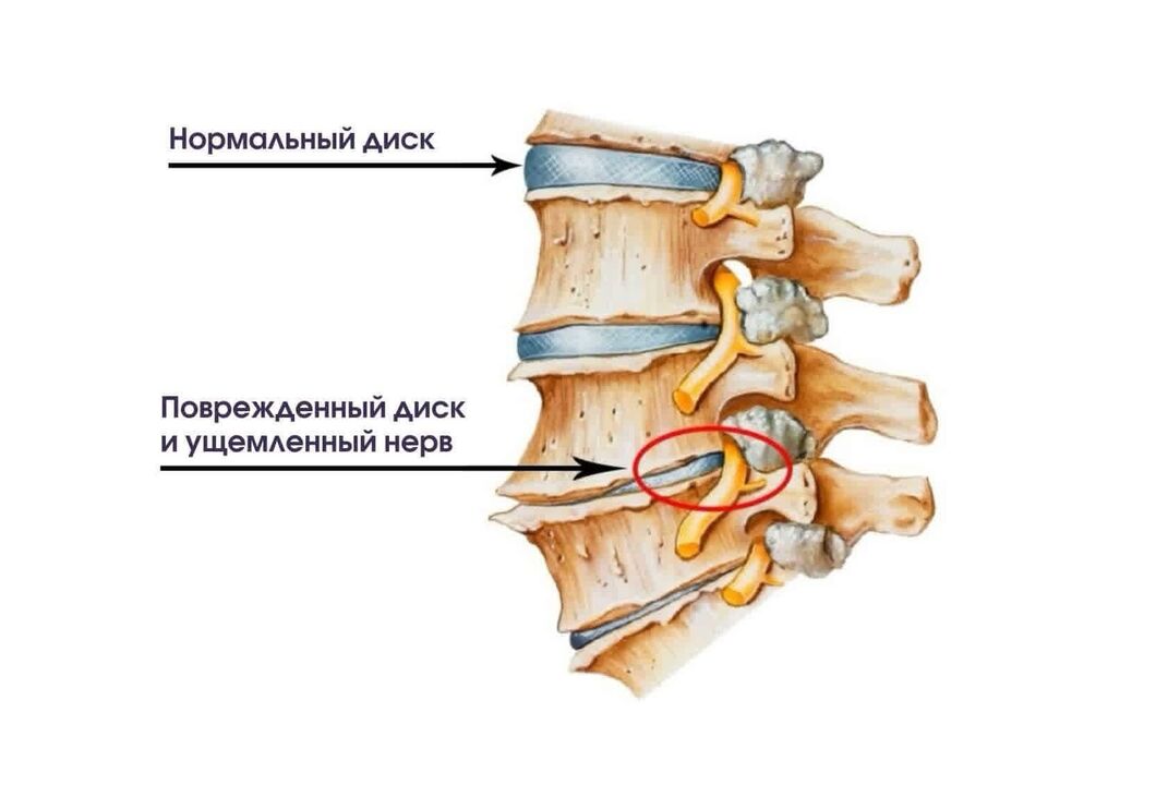 រោគសញ្ញានៃជំងឺ osteochondrosis មាត់ស្បូន