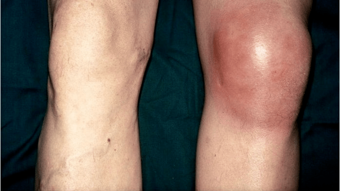 arthrosis និងជំងឺរលាកសន្លាក់